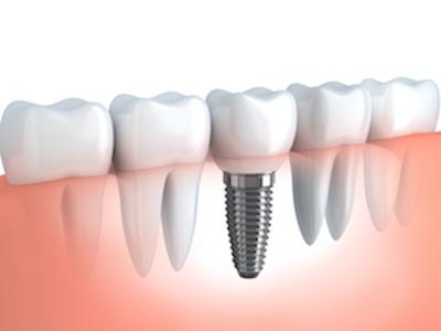 An illustration of dental implant and Crown in Beachwood, OH